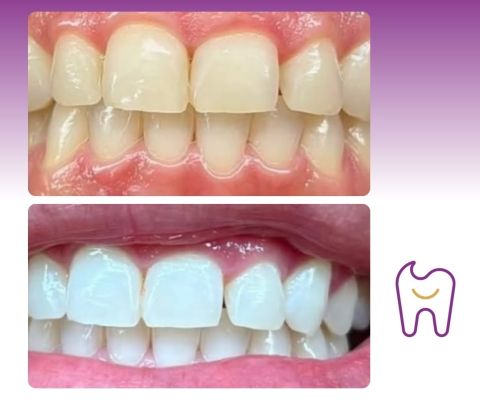 Dental plaque removal