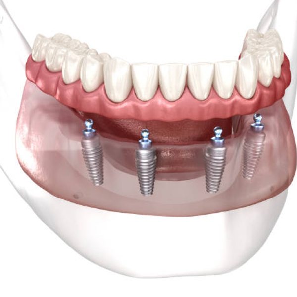 Zubní implantáty All-on-4 a All-on-6