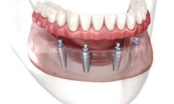 Zubní implantáty All-on-4 a All-on-6