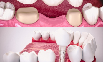 Сo je lepší - můstek nebo implantát?