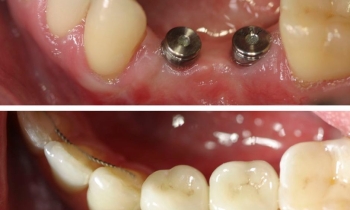 Kolik stojí zubní implantát v Praze v roce 2026?