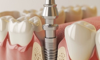 Chybí vám zub? Kdy je implantát nejlepší řešení