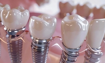 Jak probíhá zavedení zubního implantátu krok za krokem