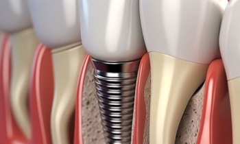 Chybí vám zub? Kdy je implantát nejlepší řešení