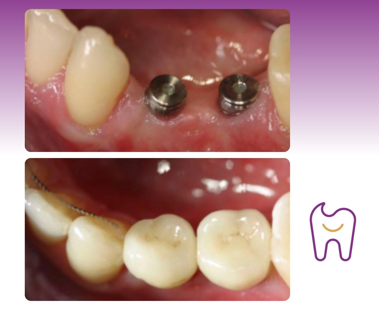 Dental Implants prague