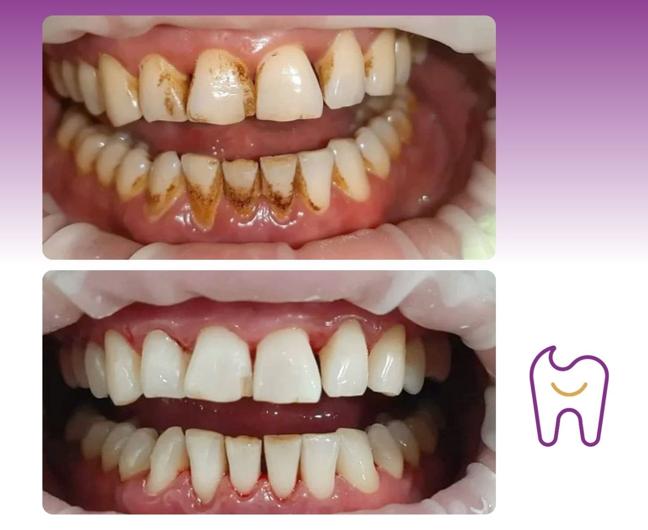 Profesion&aacute;ln&iacute; dent&aacute;ln&iacute; hygiena