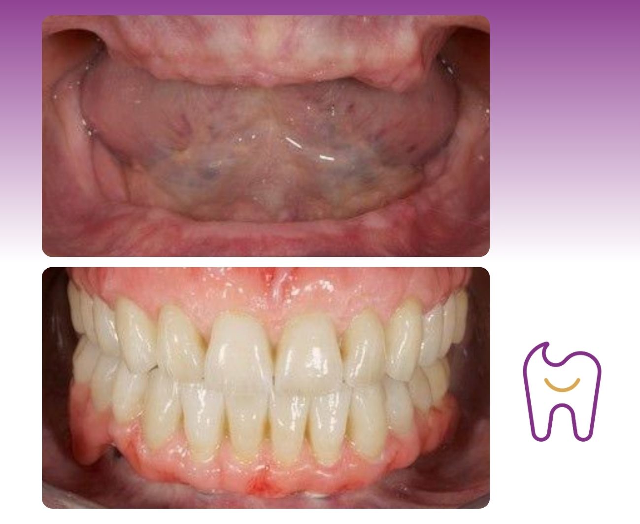 Removable Dentures