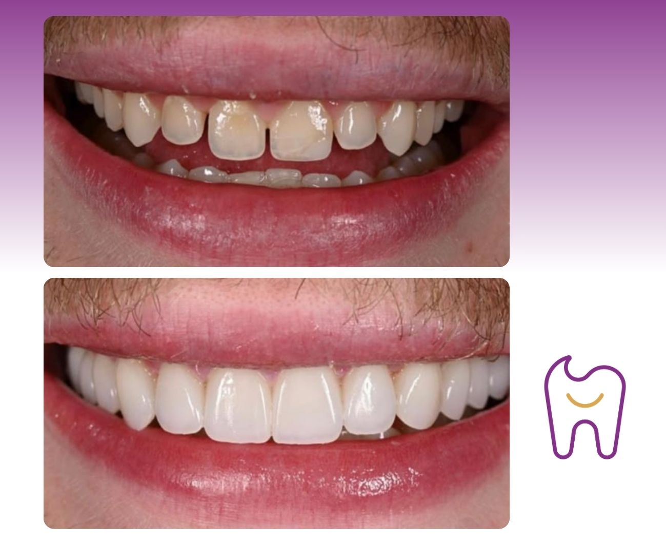 Veneers