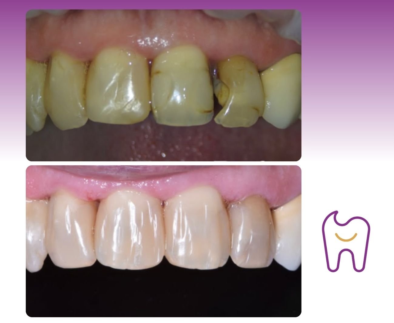 Aesthetic Composite Restoration