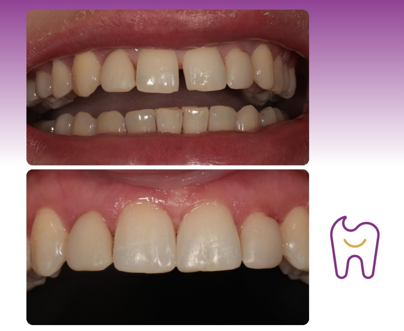 Composite Resin Restoration