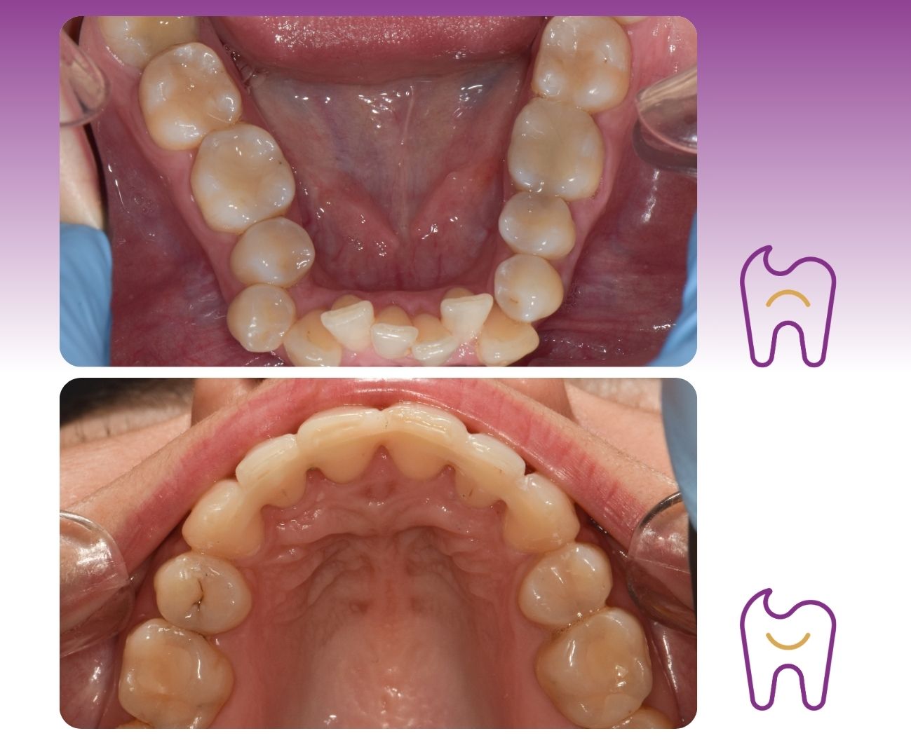Orthodontic treatment