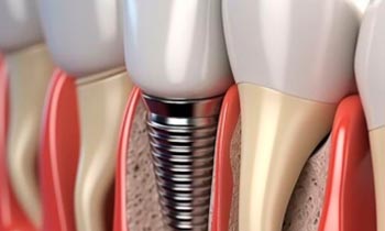 Letní. limitovaná akce na druhý zubní implantát s 50% slevou a konzultace zdarma