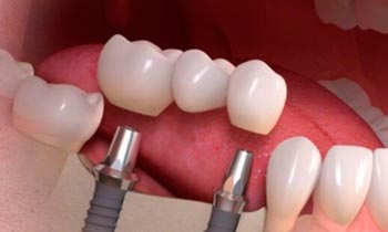Implantát vs. můstek: co je lepší řešení při ztrátě zubu