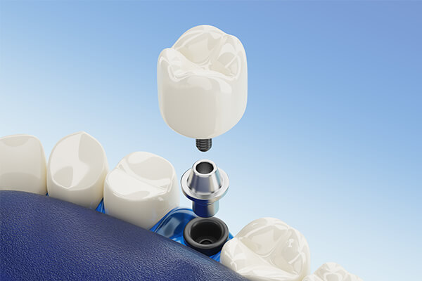 Zubní implantáty