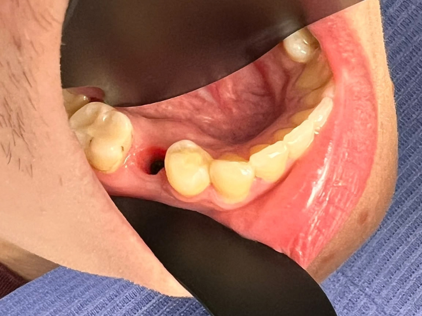 Zavedení zubního implantátu krok 1 – příprava kostního lůžka v dásni Smile Centrum Praha