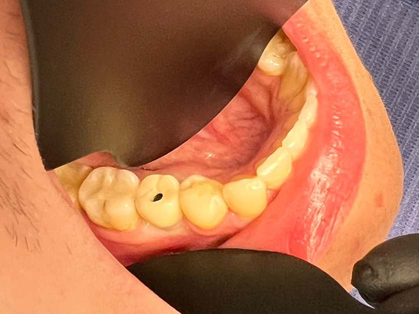 Zavedení zubního implantátu krok 4 – nasazení provizorní korunky na dobu hojení (3 měsíce)